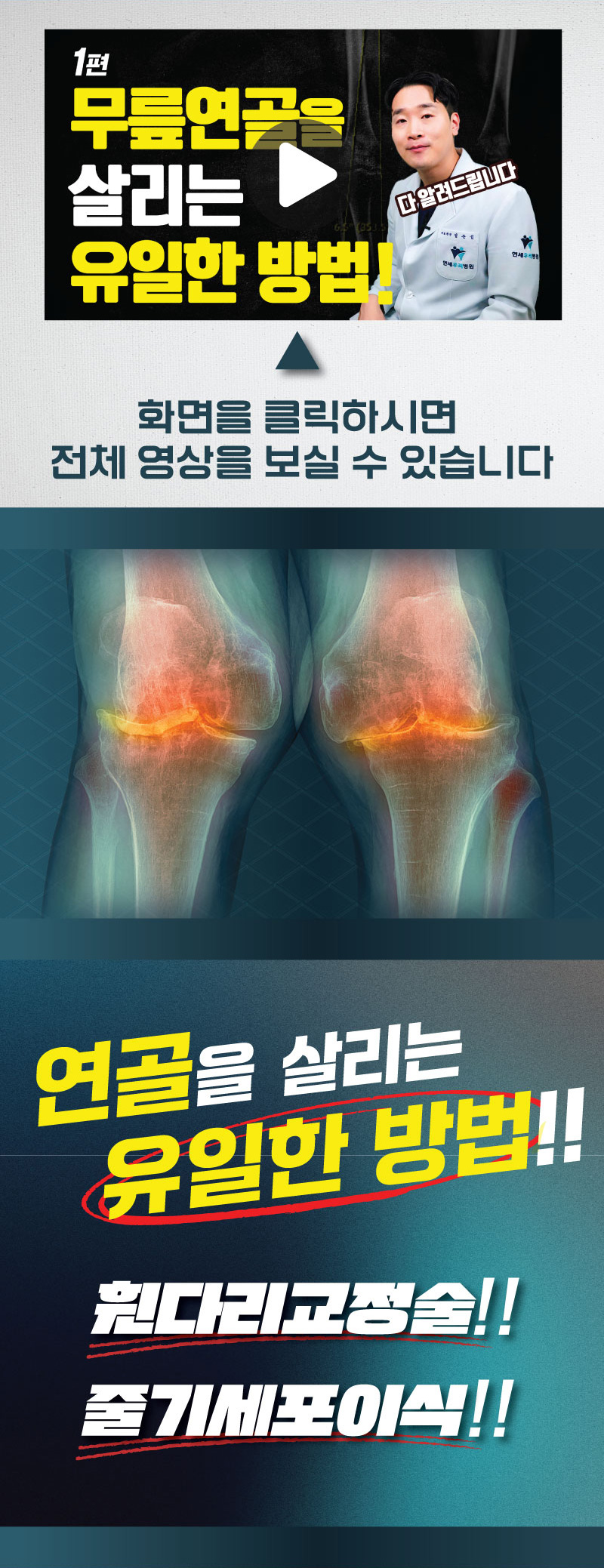 연골을 살리는 유일한 방법!!