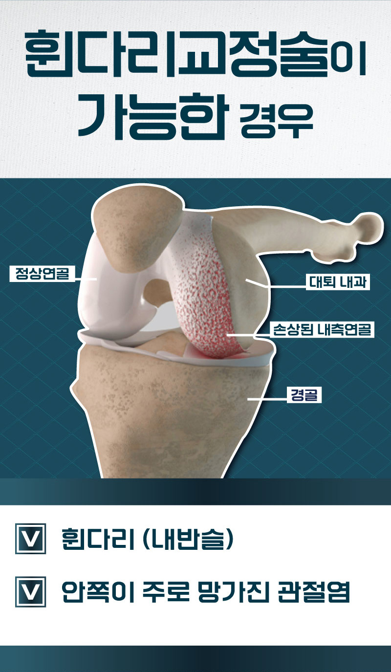 휜다리교정술이 가능한 경우