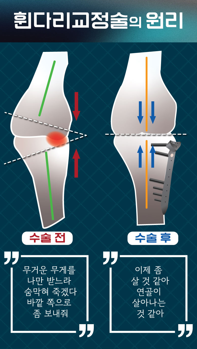 휜다리교정술의 원리