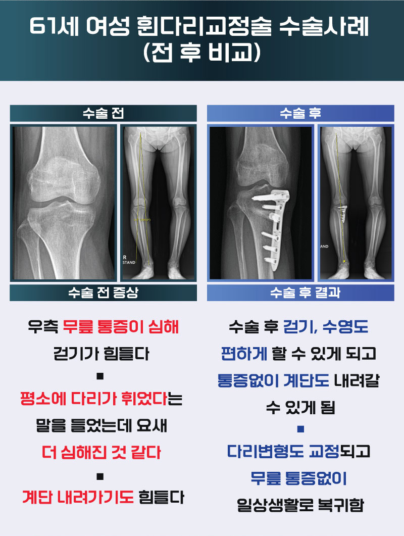 61세 여성 휜다리교정술 수술사례 (전 후 비교)
