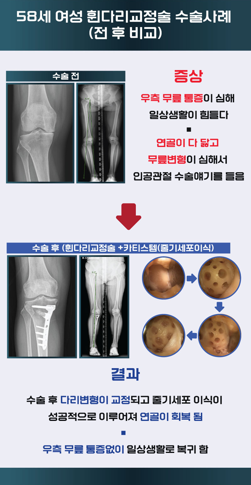 58세 여성 휜다리교정술 수술사례 (전 후 비교)