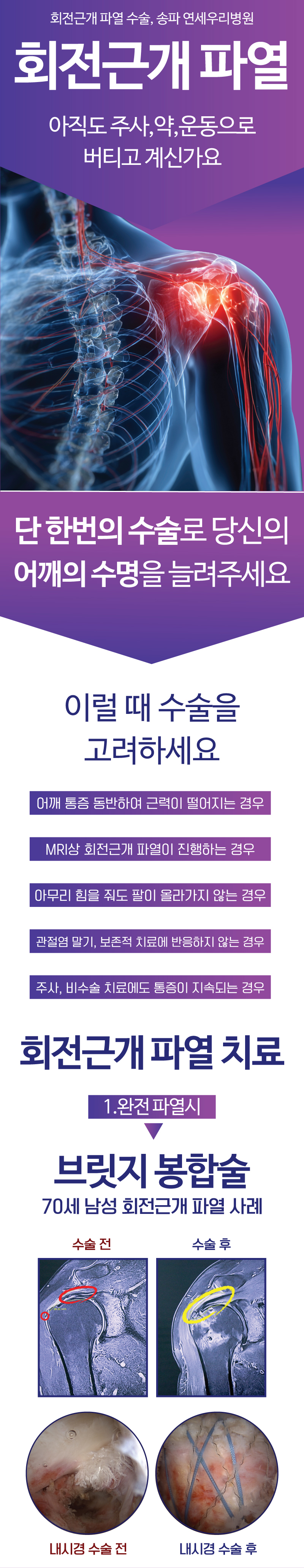 단 한번의 수술로 당신의 어깨의 수명을 늘려주세요