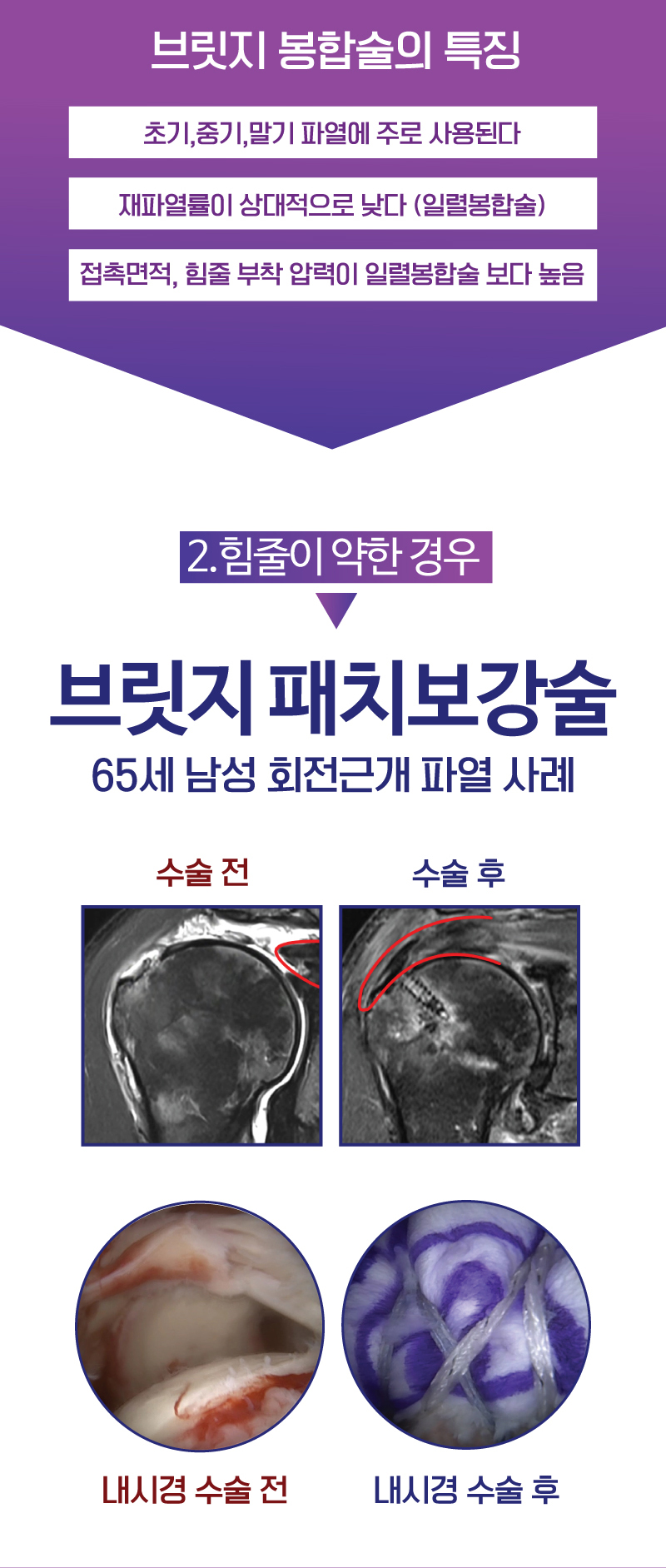 브릿지 봉합술 - 1.완전 파열시 / 70세 남성 회전근개 파열 사례