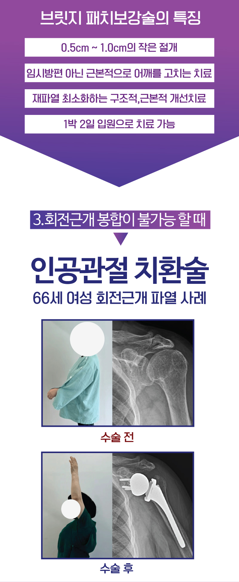 브릿지 패치보강술 - 2.힘줄이 약한 경우 / 65세 남성 회전근개 파열 사례